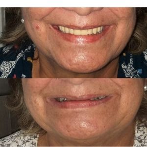 mujer con una prótesis dental