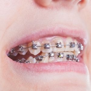 Dientes con ortodoncia