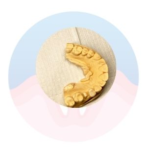 Incrustaciones Dentales